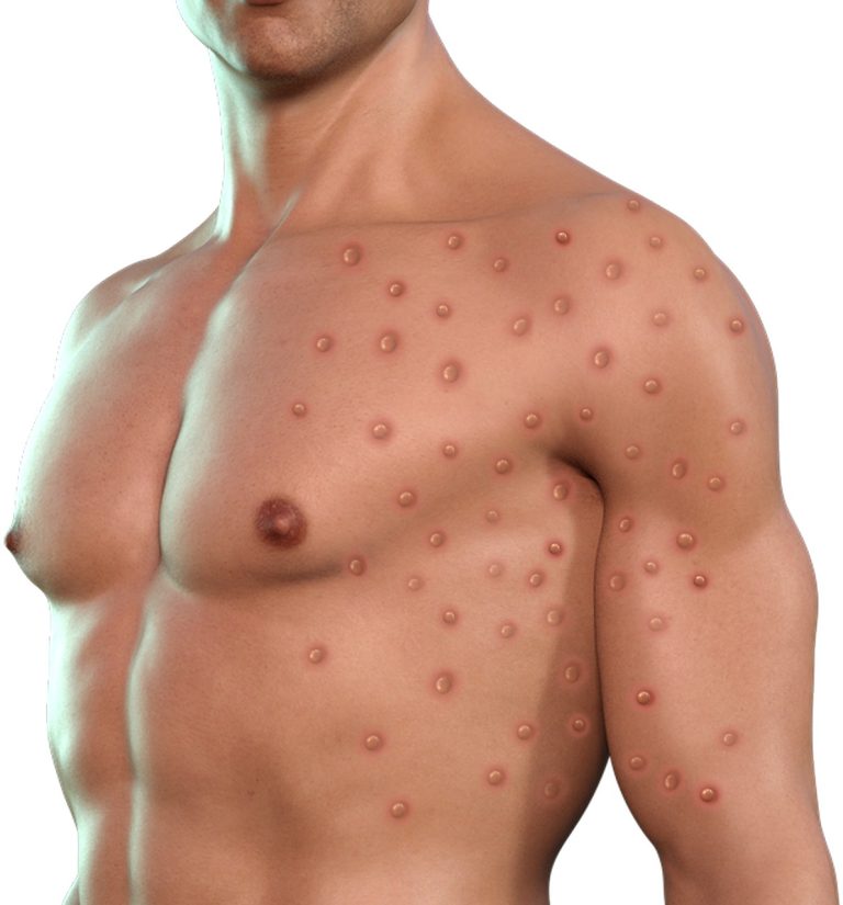 Monkeypox Monkeypox rash pictures